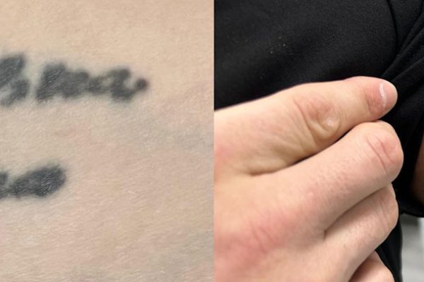 before_after-Matt-Arm