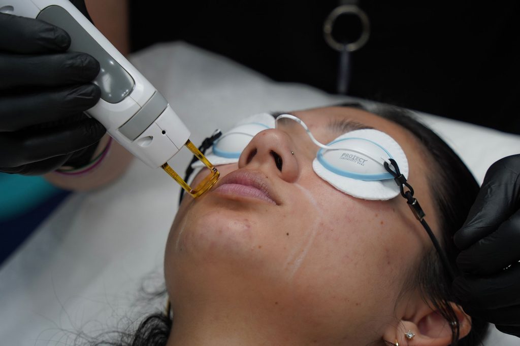 coastal-laser-hair-removal-4