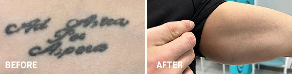 before_after-Matt-Arm2